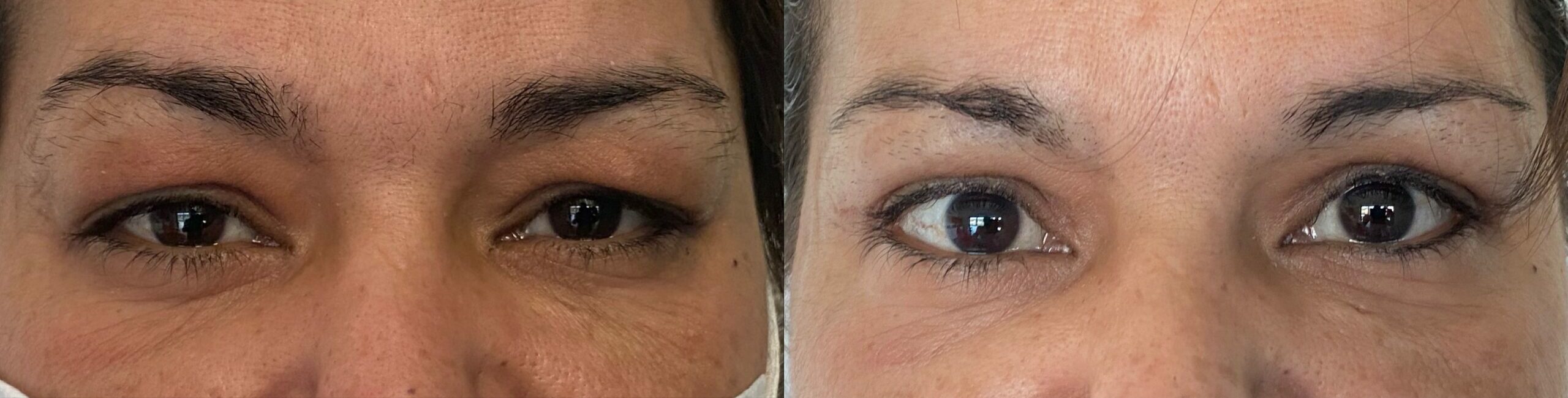 comparaison entre avant et après la chirurgie