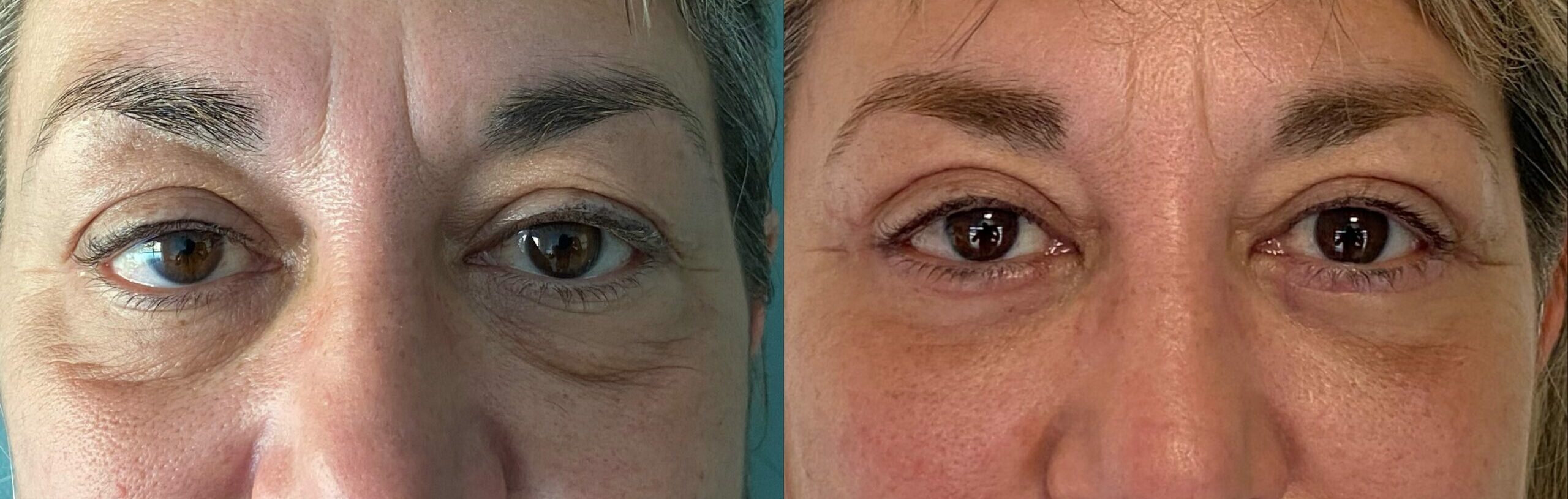 comparaison entre avant et après la chirurgie