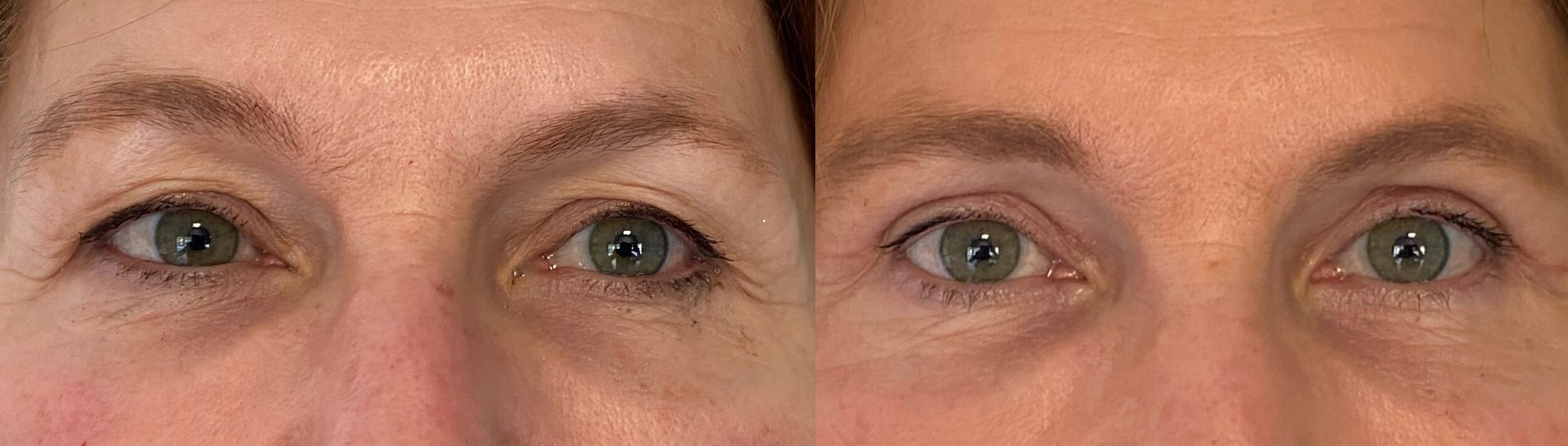 comparaison entre avant et après la chirurgie