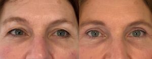 Avant apres resultat blepharoplastie superieure avec le Dr Koppe Lyon Vienne
