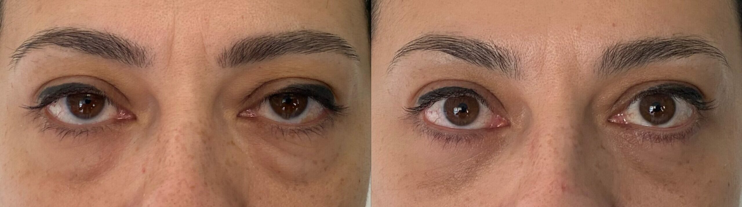 comparaison entre avant et après la chirurgie
