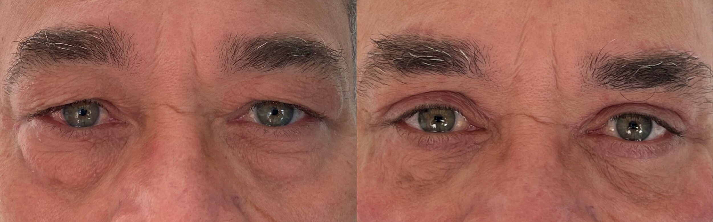 comparaison entre avant et après la chirurgie