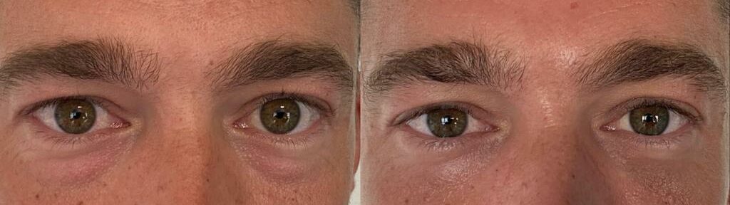 comparaison entre avant et après la chirurgie