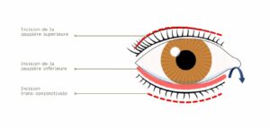 Blépharoplastie supérieure, Blépharoplastie inférieure