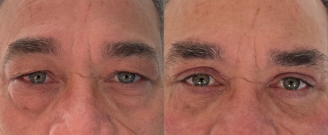 blépharoplastie ou chirurgie des paupières