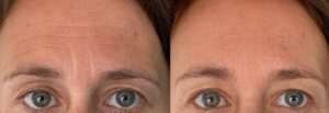 botox front avant après (toxine botulique)