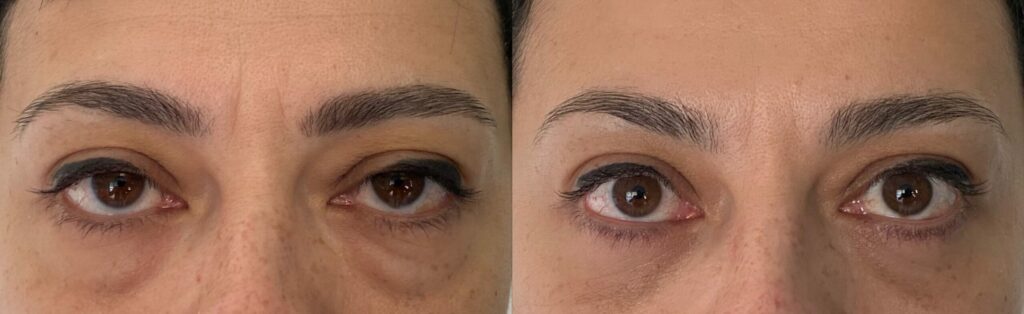 blépharoplastie inférieure avant après​