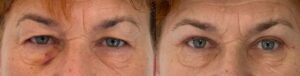 avis blépharoplastie supérieure Avant/après
