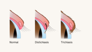 Schéma pour illustrer l'anomalie des cils.