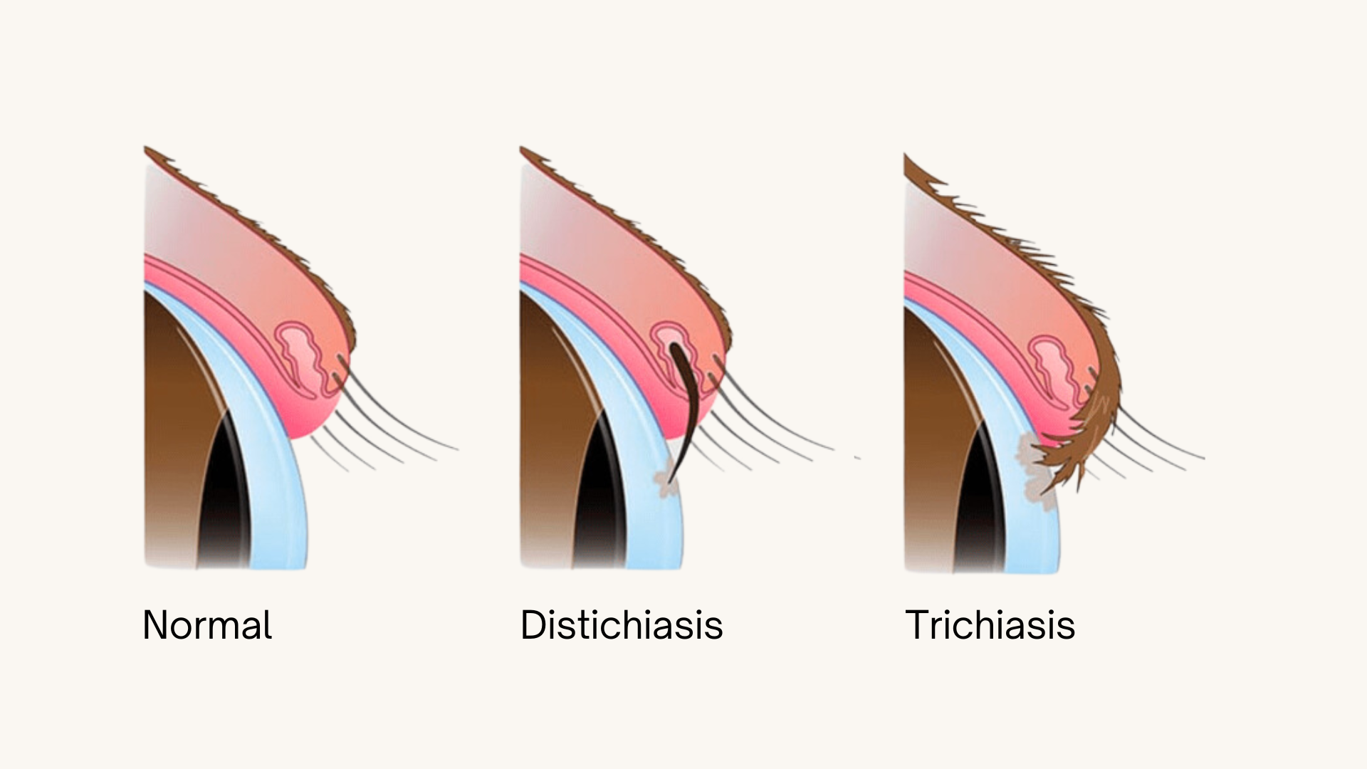 Distrachiasis Trichiasis et distichiasis correction des anomalies des cils