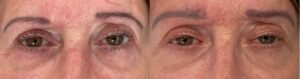 avant apres lifting sourcills asymetrie correction chirurgie dr koppe lyon vienne