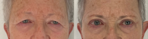 Blépharoplastie supérieure paupière tombante avant après LYON