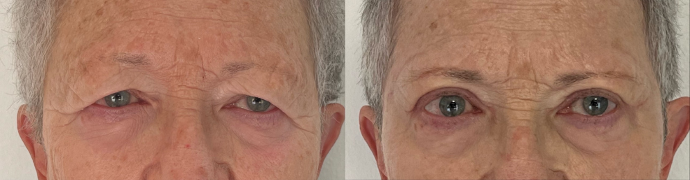 comparaison entre avant et après la chirurgie