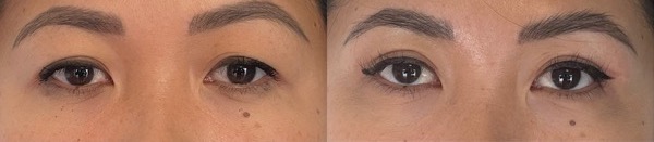 Resultat avant apres blepharoplastie superieure yeux brides asiatiques dr koppe lyon vienne