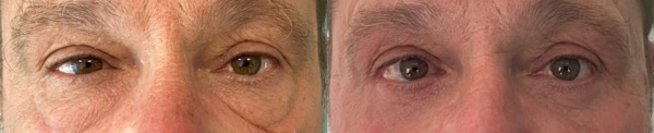 Avant après blépharoplastie inférieure cerne excès de peau dr koppe lyon vienne