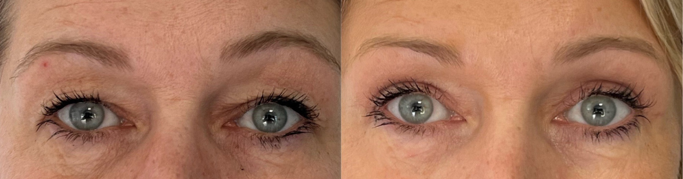 comparaison entre avant et après la chirurgie