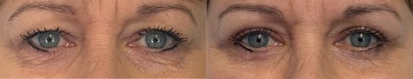 paupieres tombantes blepharoplastie avant apres dr koppe lyon vienne