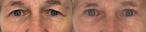 operation paupieres tombantes blepharoplastie femme dr koppe chirurgien esthetique lyon vienne
