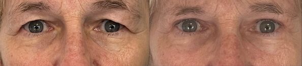 operation paupieres tombantes blepharoplastie femme dr koppe chirurgien esthetique lyon vienne
