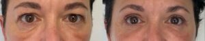 blepharoplastie superieure et inferieure operation paupieres avant apres poche malaire docteur koppe lyon vienne