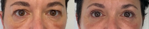 blepharoplastie superieure et inferieure operation paupieres avant apres poche malaire docteur koppe lyon vienne