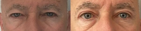 chirurgie paupieres tombantes operation paupiere regard homme blepharoplastie superieure dr koppe lyon vienne