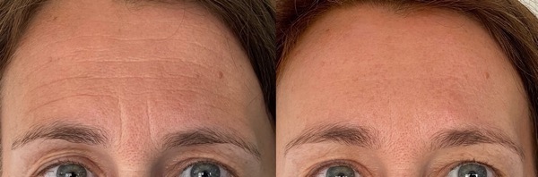 avant apres botox injection rides front dr koppe lyon vienne quel age