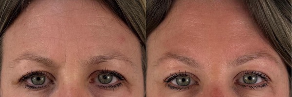 Resultat avant apres botox dr koppe age lyon vienne