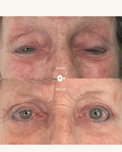 ptosis des deux paupieres sourcils hauts asymetriques compensation dr koppe lyon vienne chirurgie regard