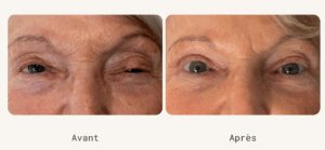Traitement chirurgie ptosis vision blepharoplastie paupiere tombante dr koppe lyon vienne avant apres