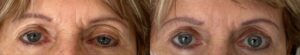ptose palpbrale ptosis paupiere lourde chirurgie du ptosis lyon vienne Docteur Koppe