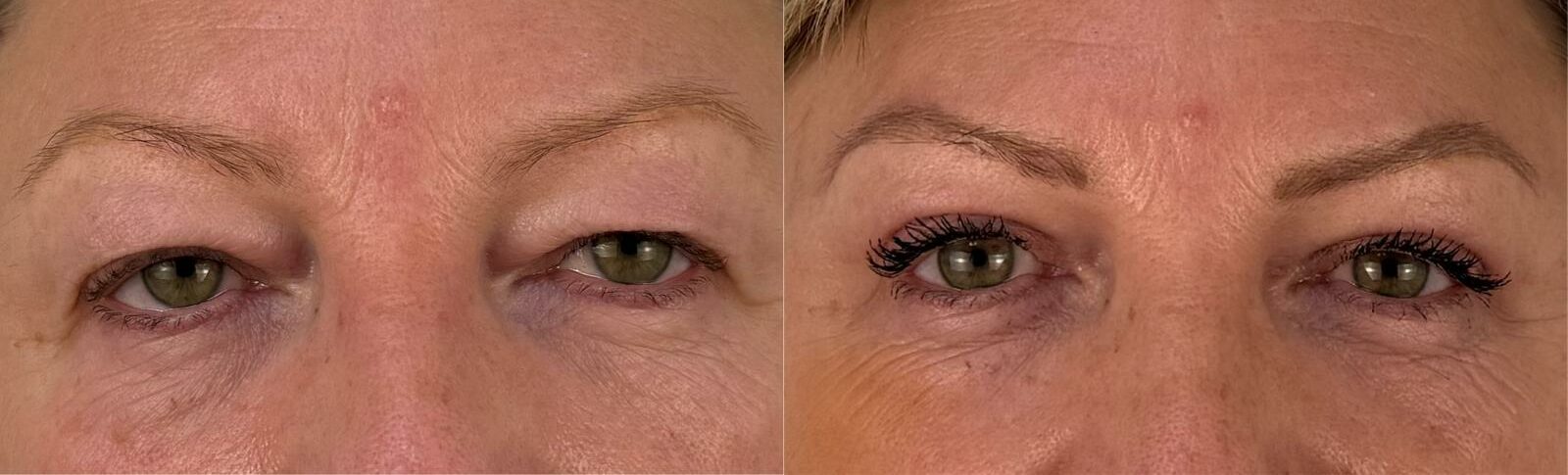 comparaison entre avant et après la chirurgie