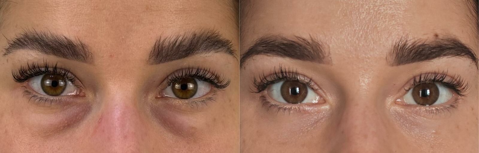 comparaison entre avant et après la chirurgie