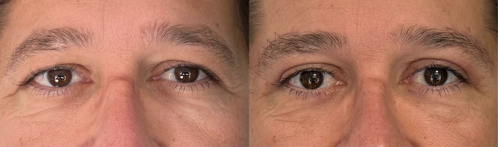 comparaison entre avant et après la chirurgie