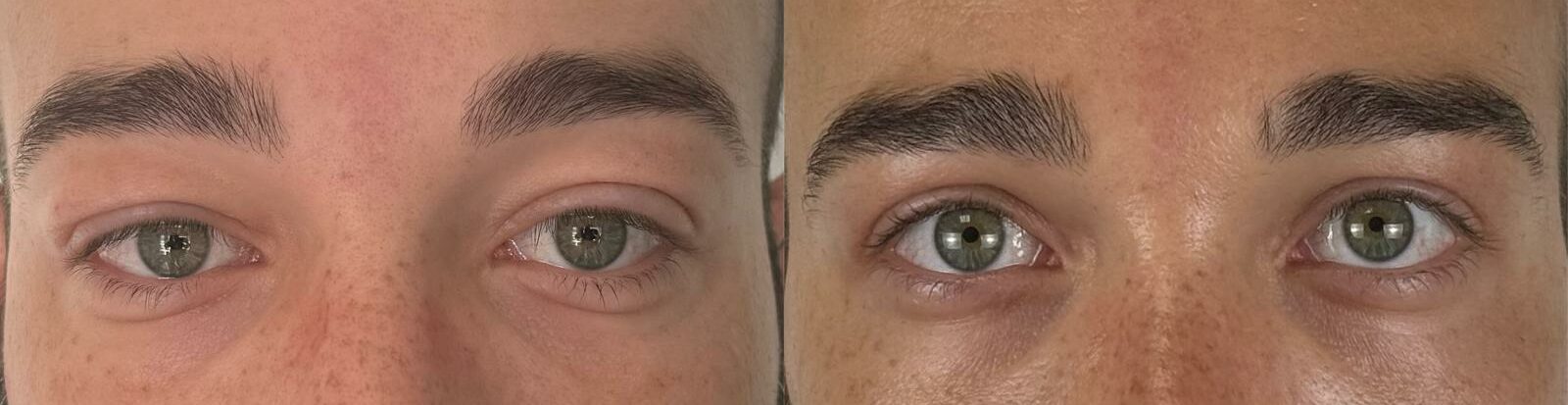 comparaison entre avant et après la chirurgie