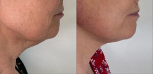 lifting cervico-facial avec le Dr Koppe