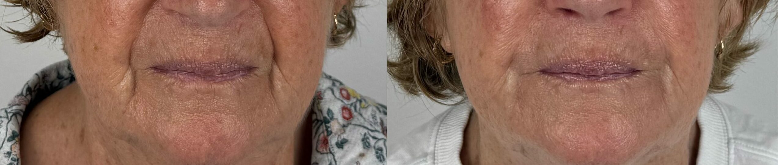 comparaison entre avant et après la chirurgie
