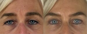 Blépharoplastie supérieure et lifting sourcilier cure de ptosis, pinch et botox
