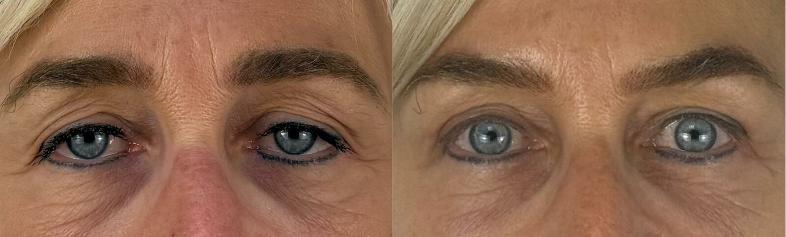 comparaison entre avant et après la chirurgie