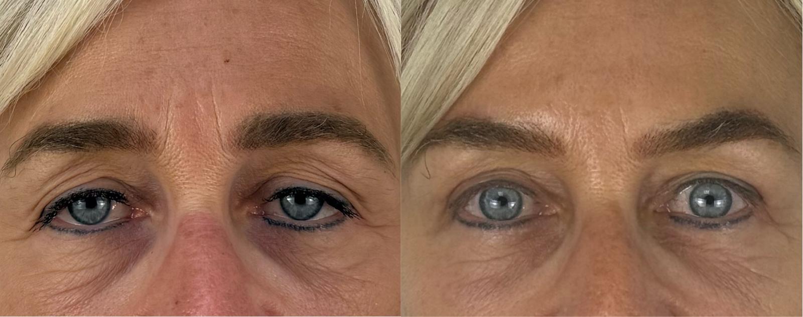 comparaison entre avant et après la chirurgie