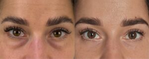 blépharoplastie inférieure faite par le Dr. Koppe