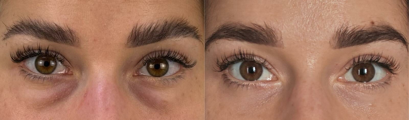 comparaison entre avant et après la chirurgie