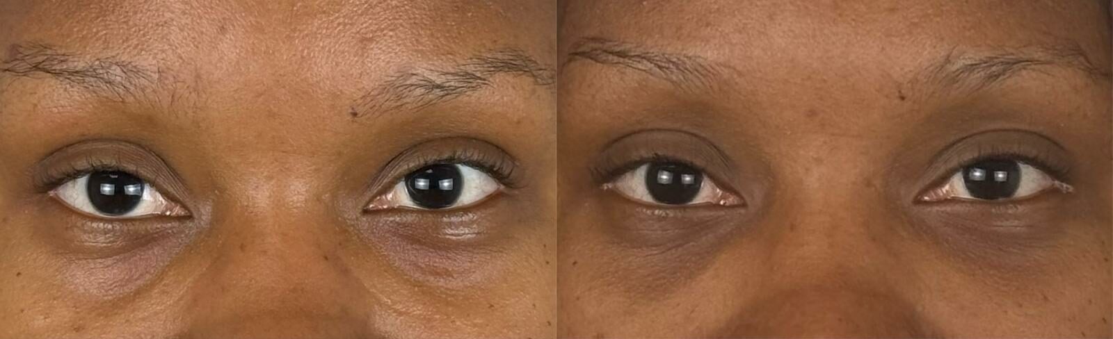 comparaison entre avant et après la chirurgie