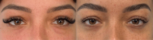 blépharoplastie inférieure Dr. Koppe
