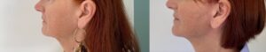 avant apres lifting du visage cou dr koppe lyon vienne naturel 