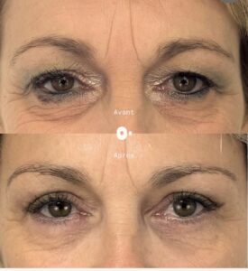 blepharoplastie superieure pinch chirurgie esthetique paupieres dr koppe lyon vienne