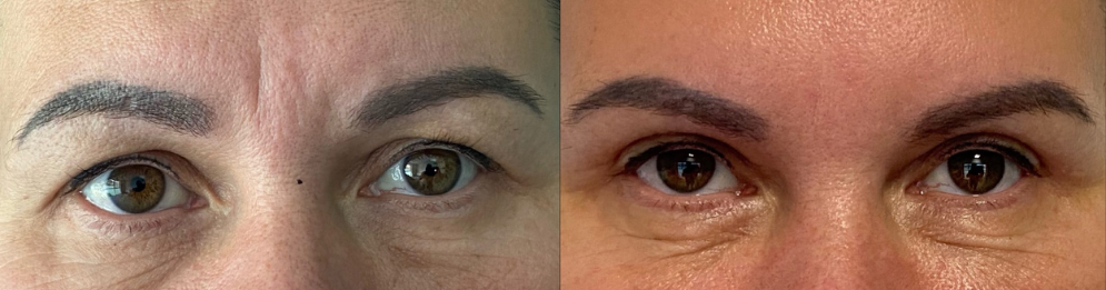 comparaison entre avant et après la chirurgie