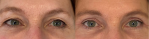 Avant après blépharoplastie supérieure réalisée par le Dr. Koppe