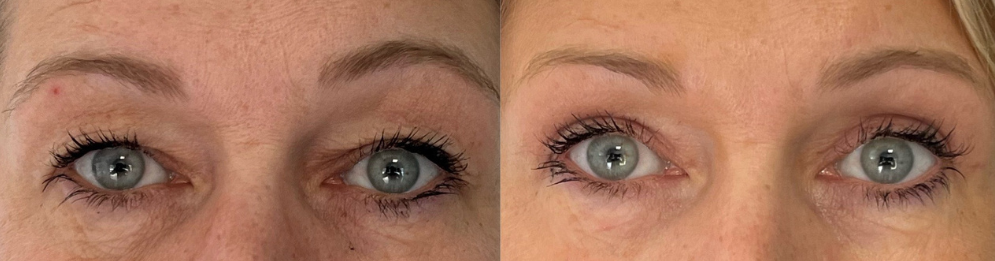 comparaison entre avant et après la chirurgie