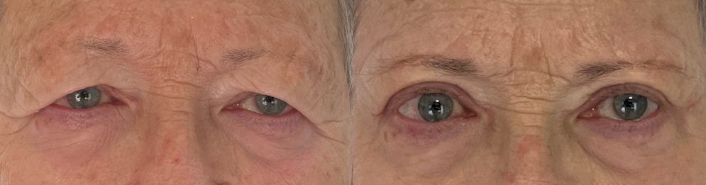 comparaison entre avant et après la chirurgie